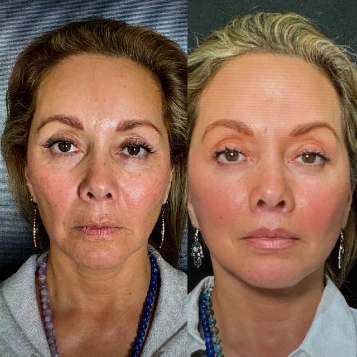 Blefaroplastia + Deep Plane Lifting Antes y Después