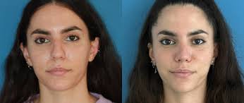 Mentoplastia Antes y Después