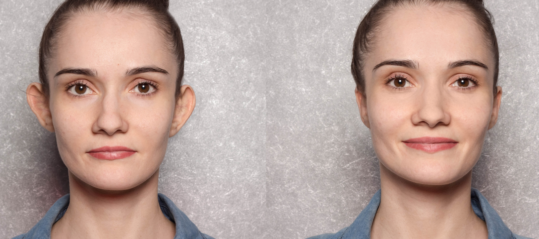 Otoplastia Antes y Después